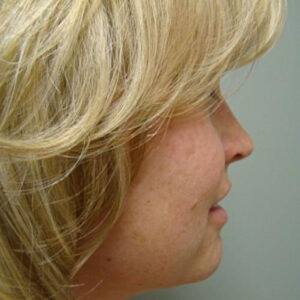 Neck Liposuction before and after photos