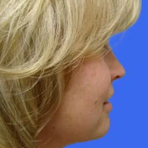 Neck Liposuction before and after photos