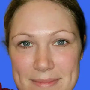 Ear Surgery before and after photos