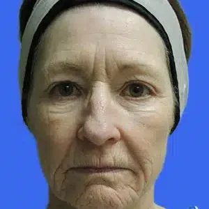 Face Lift before and after photos