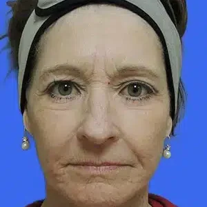 Face Lift before and after photos