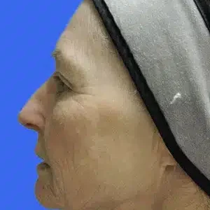 Face Lift before and after photos