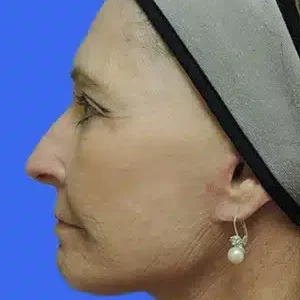 Face Lift before and after photos