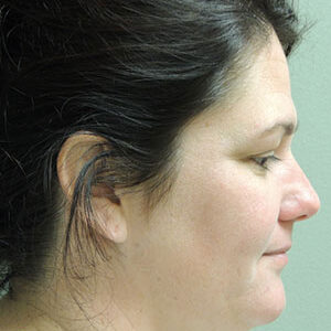 Laser Lift before and after photos