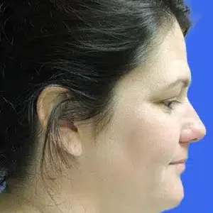 Laser Lift before and after photos