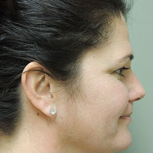 Laser Lift before and after photos