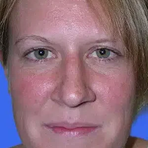 Rhinoplasty before and after photos