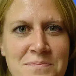 Rhinoplasty before and after photos