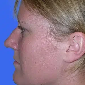 Rhinoplasty before and after photos