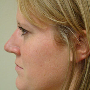 Rhinoplasty before and after photos