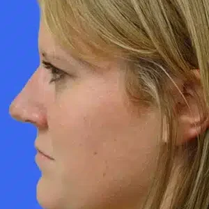 Rhinoplasty before and after photos