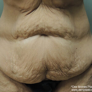 Tummy Tuck before and after photos