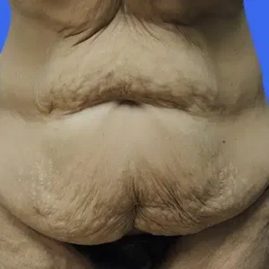 Tummy Tuck before and after photos Tummy Tuck before and after photos