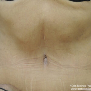 Tummy Tuck before and after photos