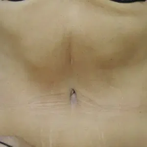 Tummy Tuck before and after photos Tummy Tuck before and after photos