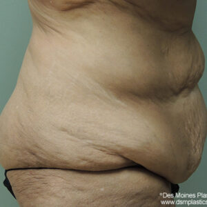 Tummy Tuck before and after photos