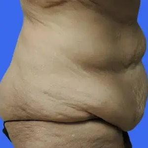 Tummy Tuck before and after photos Tummy Tuck before and after photos