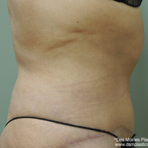 Tummy Tuck before and after photos