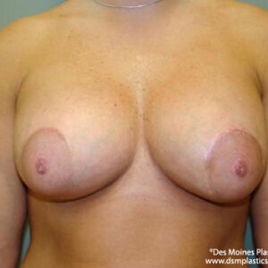 Breast Lift with Augmentation before and after photos