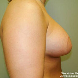 Breast Lift with Augmentation before and after photos