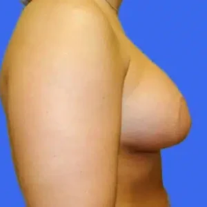 Breast Lift with Augmentation before and after photos