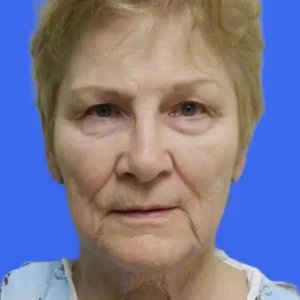 Face Lift before and after photos