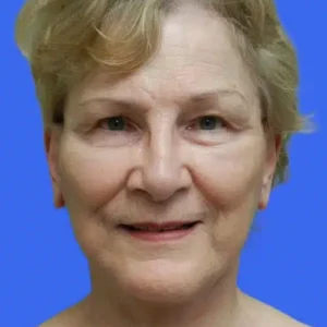 Face Lift before and after photos