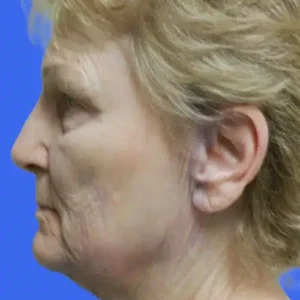 Face Lift before and after photos