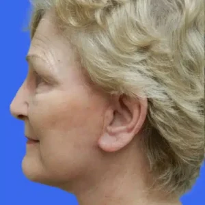 Face Lift before and after photos