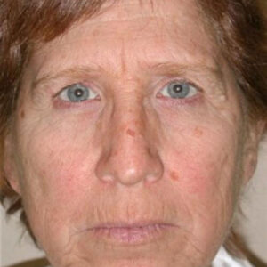Brow Lift before and after photos