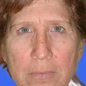 Brow Lift before and after photos