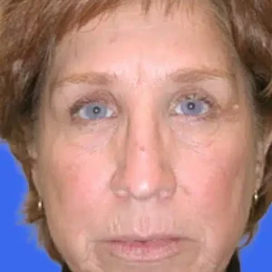 Brow Lift before and after photos