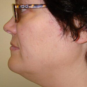 Neck Liposuction before and after photos