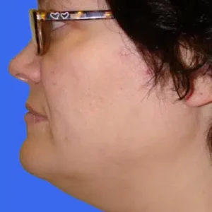 Neck Liposuction before and after photos
