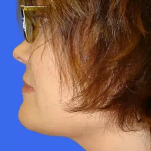 Neck Liposuction before and after photos