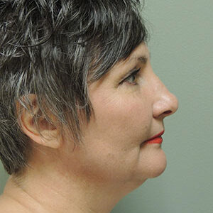 Laser Lift before and after photos