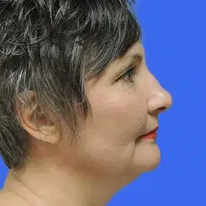 Laser Lift before and after photos