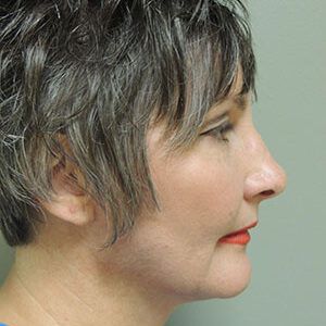 Laser Lift before and after photos