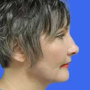 Laser Lift before and after photos