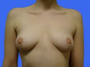 Breast Lift before and after photos Breast Lift before and after photos