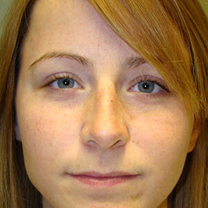 Rhinoplasty before and after photos