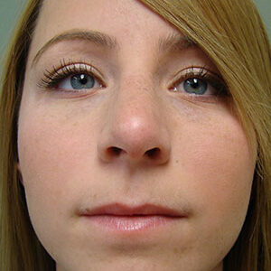 Rhinoplasty before and after photos