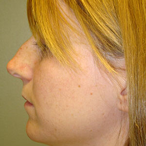 Rhinoplasty before and after photos