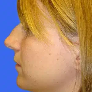 Rhinoplasty before and after photos