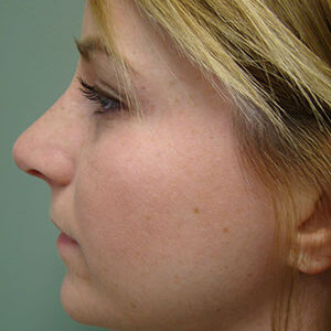 Rhinoplasty before and after photos