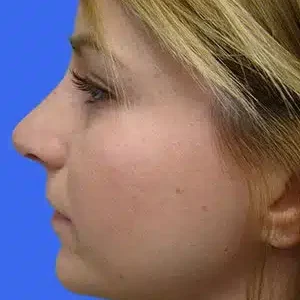 Rhinoplasty before and after photos