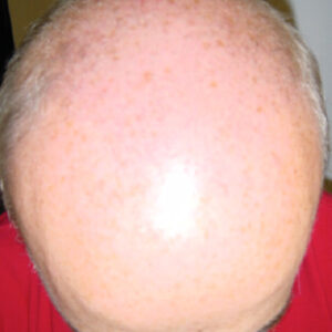 Neograft Hair Loss Replacement before and after photos