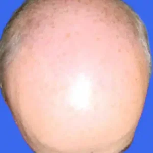 Neograft Hair Loss Replacement before and after photos
