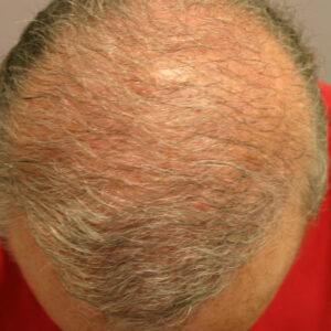 Neograft Hair Loss Replacement before and after photos