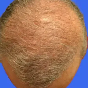 Neograft Hair Loss Replacement before and after photos